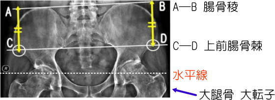 理学療法評価法 骨盤について